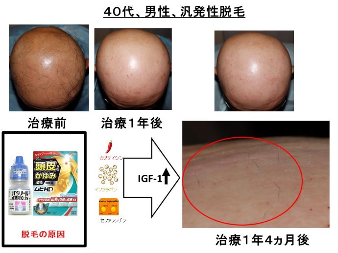 円形脱毛症　病院